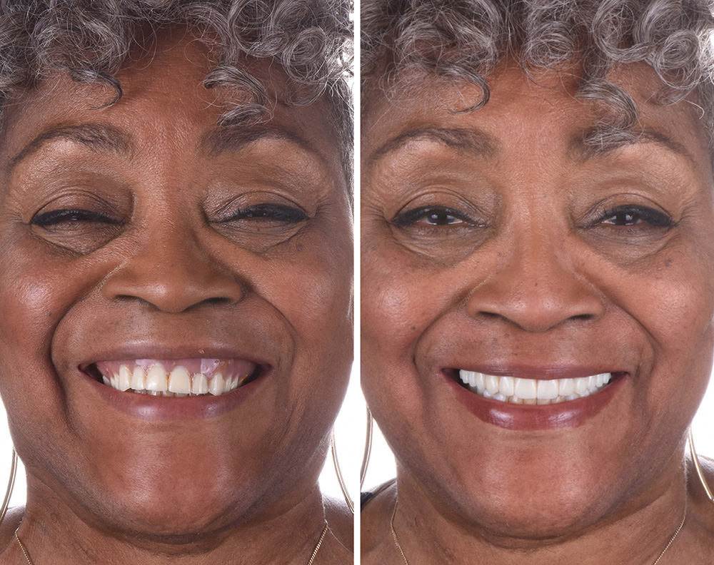 ANEWU dental implant patient before and after