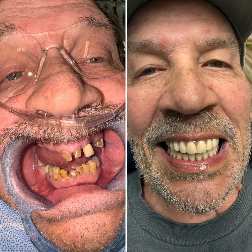 ANEWU dental implant patient before and after