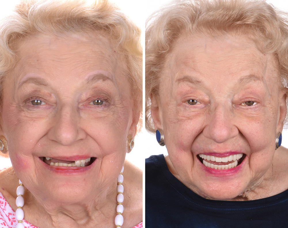ANEWU dental implant patient before and after