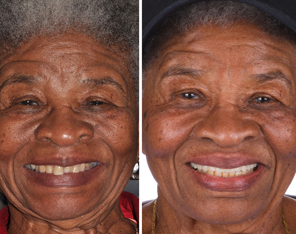 ANEWU dental implant patient before and after