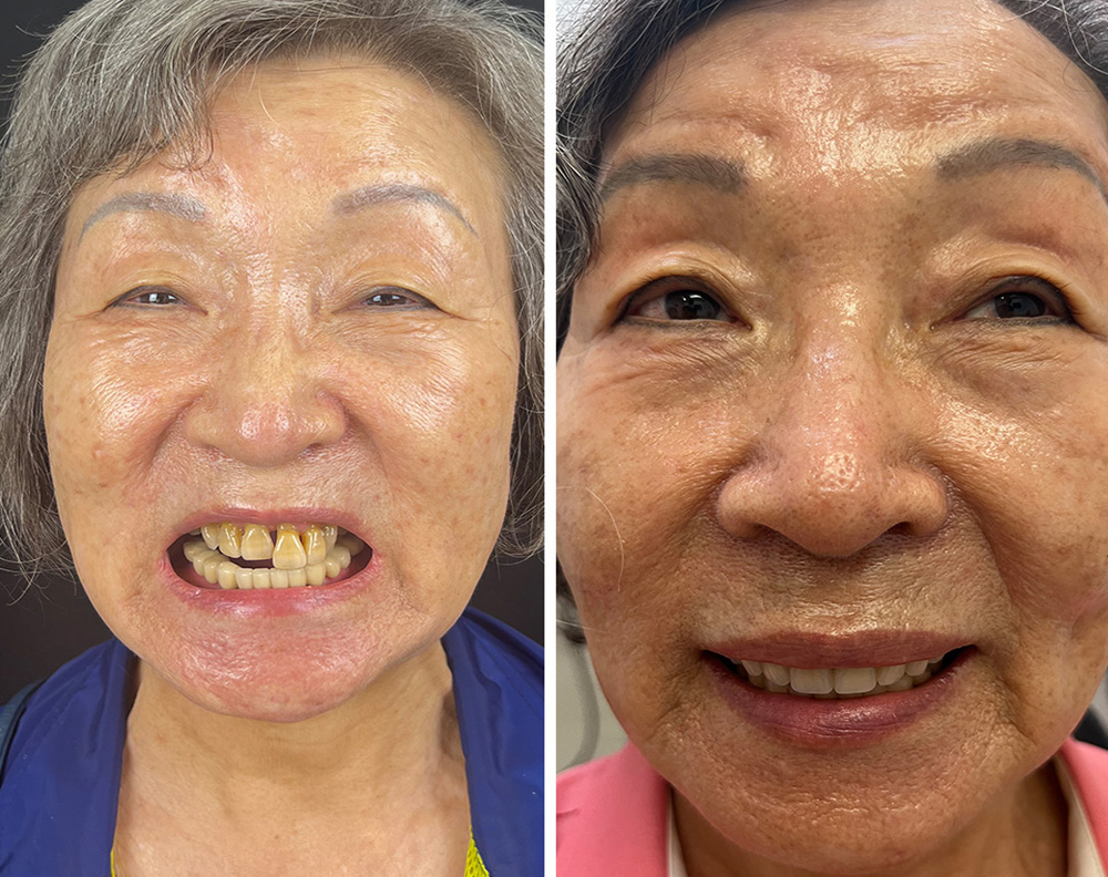 ANEWU dental implant patient before and after