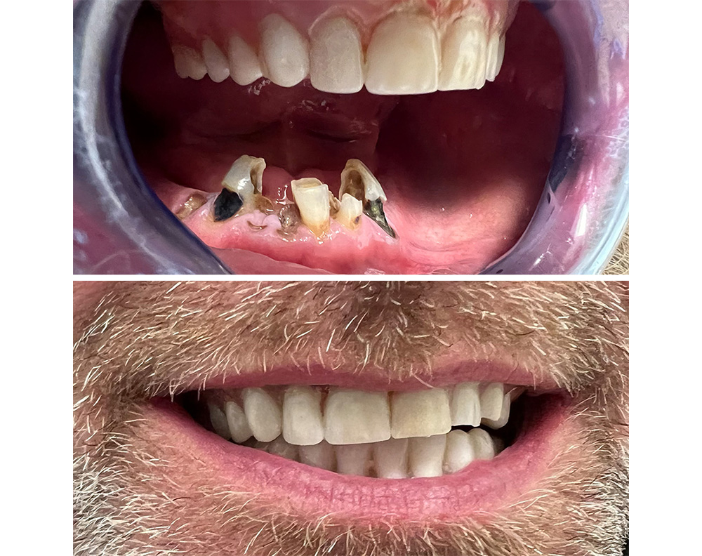 Real ANEWU patient, before and after dental implant treatment