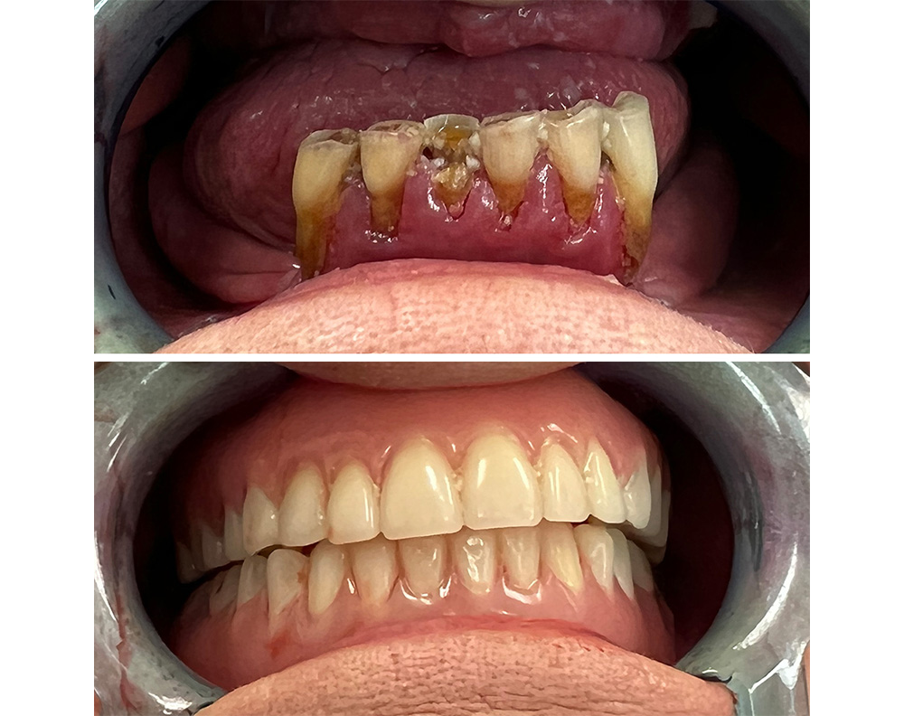 ANEWU dental implant patient before and after