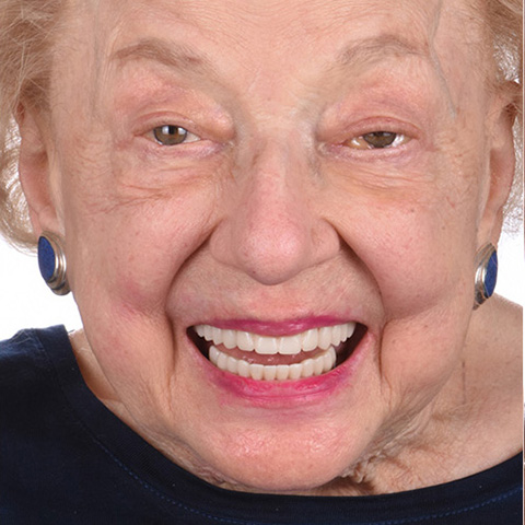 A real ANEWU patient's smile after full-arch dental implant treatment