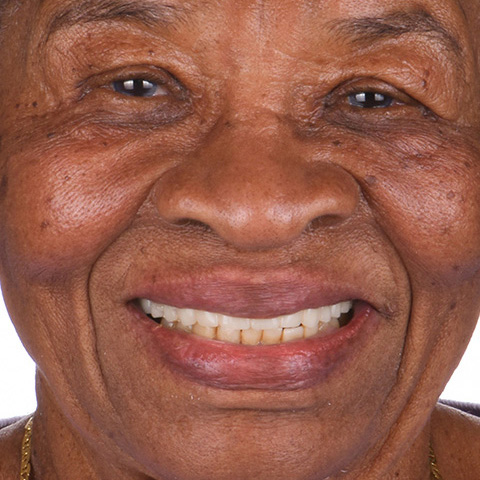 The same patient's smile after full-arch dental implant treatment