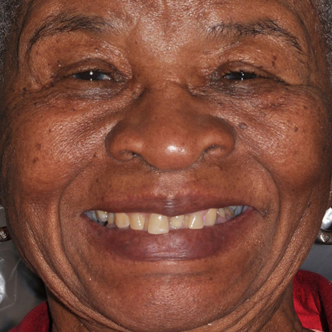 A patient's smile before full-arch dental implant treatment