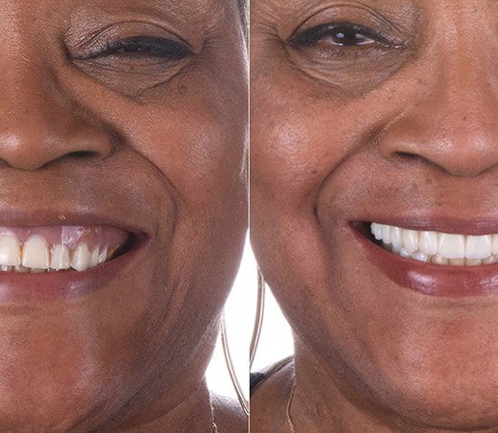 A real ANEWU patient's smile before and after full-arch dental implant treatment