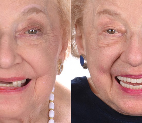 A real ANEWU patient's smile before and after full-arch dental implant treatment