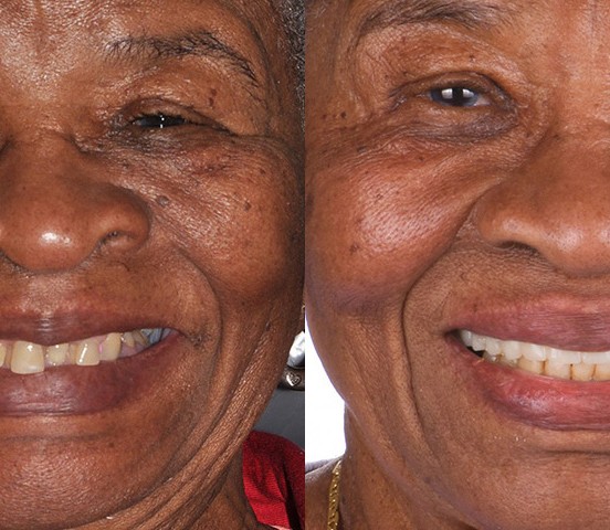 A real ANEWU patient's smile before and after full-arch dental implant treatment