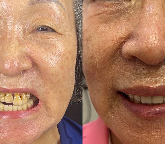 A real ANEWU patient's smile before and after full-arch dental implant treatment